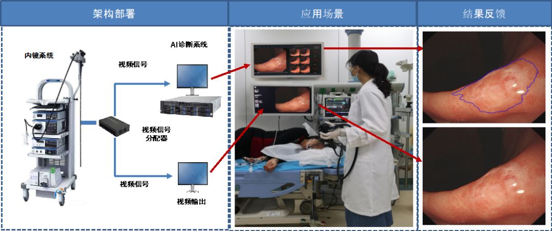 腫瘤早診的“火眼金睛”——徐瑞華教授團(tuán)隊(duì)成功研發(fā)上消化道腫瘤內(nèi)鏡AI輔助診斷系統(tǒng)-肽度TIMEDOO