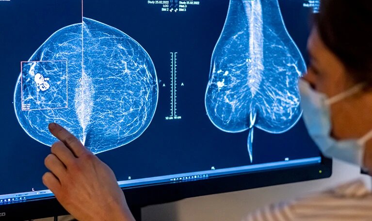 乳腺癌生存率大幅提升-肽度TIMEDOO
