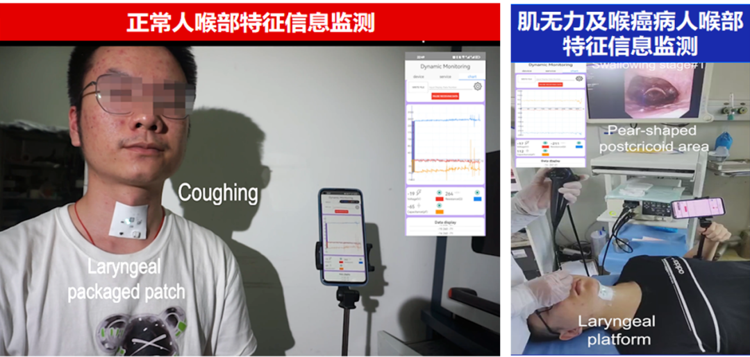 不做喉鏡也能監(jiān)測(cè)喉部康復(fù)-肽度TIMEDOO